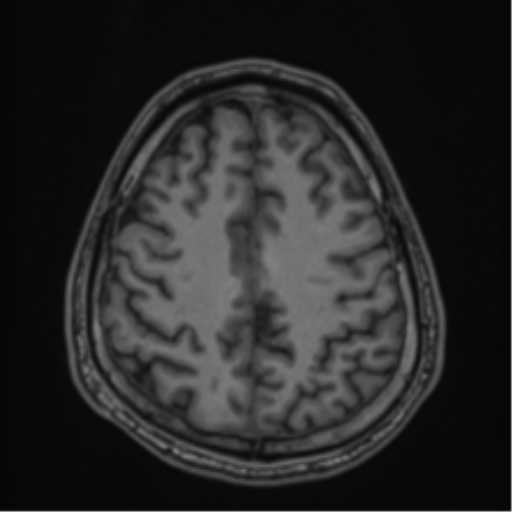 CNS vasculitis (Radiopaedia 55715-62263 Axial T1 70).png
