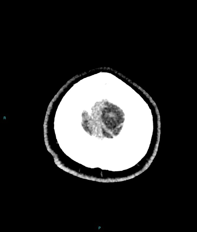 Calcified cerebral emboli from left ventricular thrombus (Radiopaedia 84420-99758 Axial non-contrast 7).jpg