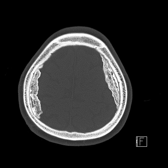 Calcified chronic subdural hematoma (Radiopaedia 77374-89492 Axial bone window 114).jpg