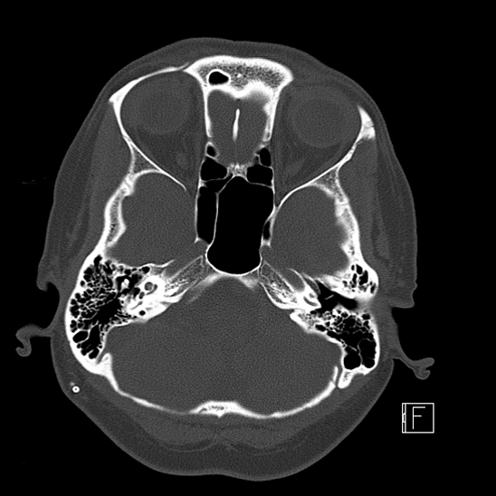 Calcified chronic subdural hematoma (Radiopaedia 77374-89492 Axial bone window 26).jpg