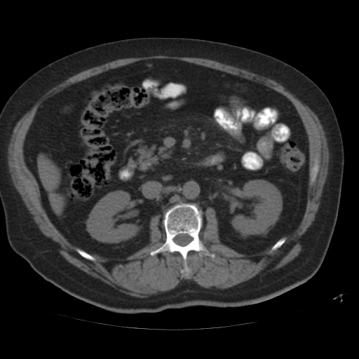 File:Calcified hepatic hydatid cyst (Radiopaedia 18907-18853 Axial non-contrast 27).jpg