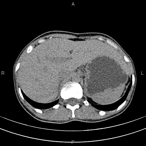 File:Calcified hepatic hydatid cyst (Radiopaedia 83870-99072 Axial non-contrast 39).jpg