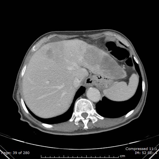 Calcified liver metastases (Radiopaedia 44699-48470 B 14).jpg