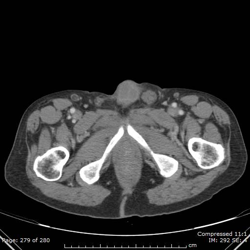 Calcified liver metastases (Radiopaedia 44699-48470 B 70).jpg
