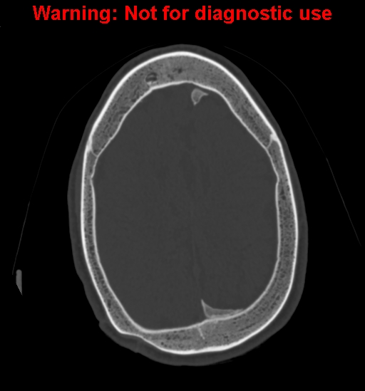 Calvarial thickening from chronic shunting (Radiopaedia 60079-67637 Axial bone window 136).jpg