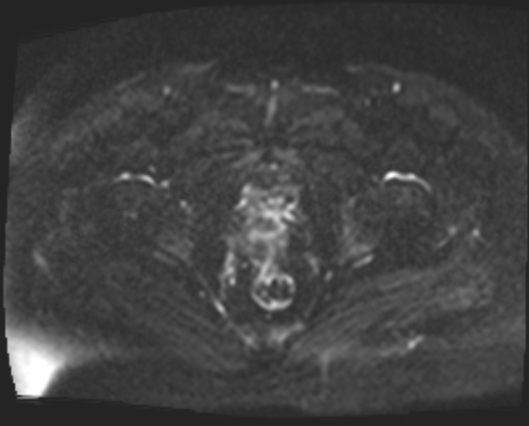 Cancer cervix - stage IIb (Radiopaedia 75411-86615 Axial DWI 35).jpg