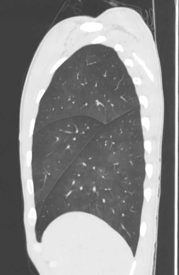 Cannabis-induced diffuse alveolar hemorrhage (Radiopaedia 89834-106946 Sagittal lung window 25).jpg