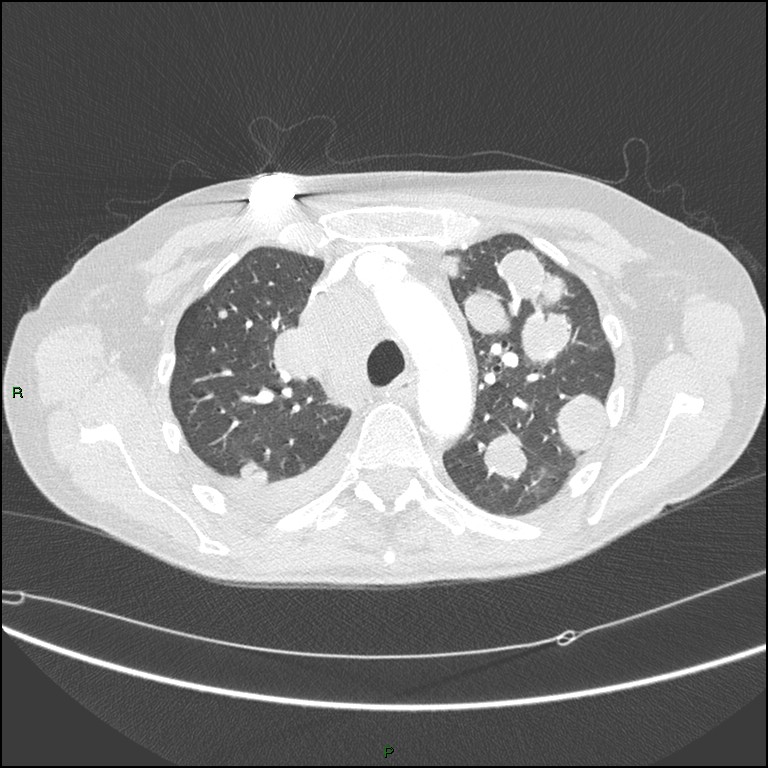 Cannonball metastases (Radiopaedia 82110-96150 Axial lung window 63).jpg