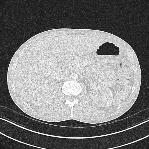 Cannonball metastases - testicular choriocarcinoma (Radiopaedia 84510-99891 Axial lung window 104).jpg
