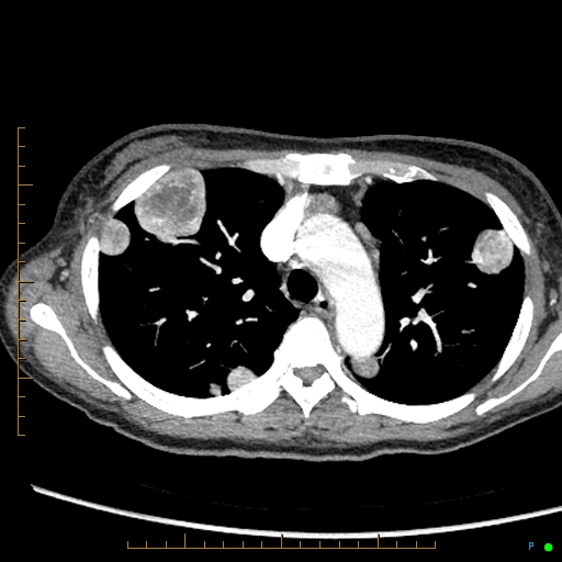 Canonball lung metastasis (Radiopaedia 77634-89837 B 28).jpg