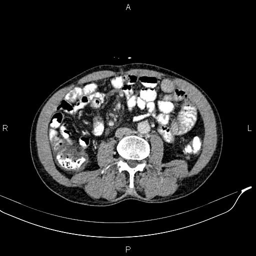 Caput medusae sign - portal hypertension (Radiopaedia 64007-72759 A 53).jpg