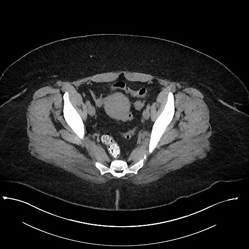 Carcinoid tumor - terminal ileum (Radiopaedia 60931-68740 Axial non-contrast 103).jpg