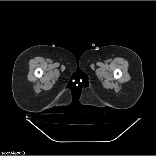 File:Carcinoma cervix- brachytherapy applicator (Radiopaedia 33135-34173 Axial non-contrast 74).jpg