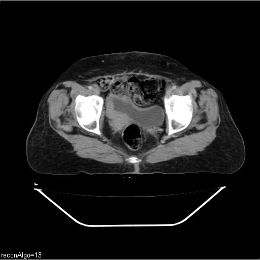 Carcinoma cervix- recurrence (Radiopaedia 34702-36137 B 48).jpg