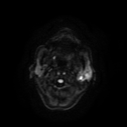 Carcinoma ex-pleomorphic adenoma of parotid (Radiopaedia 28383-28627 Ax DWI B-500 GE 54).jpg