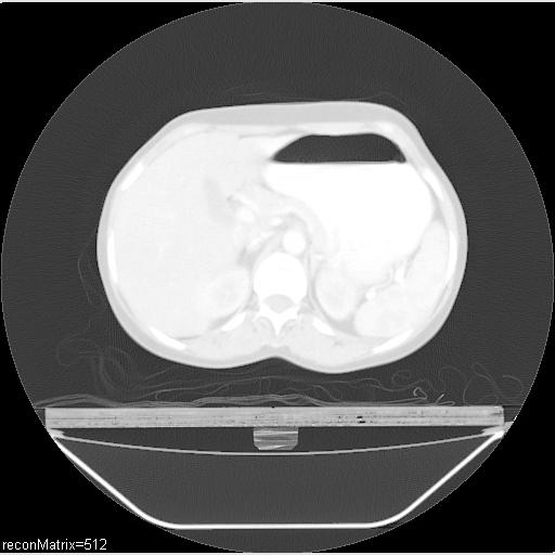 File:Carcinoma of esophagus (Radiopaedia 27356-27550 Axial lung window 1).jpg
