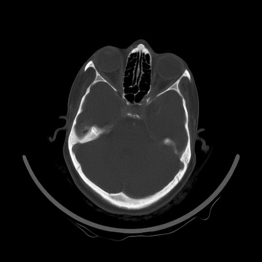 Carcinoma of the maxillary antrum (Radiopaedia 53805-59888 Axial bone window 20).jpg