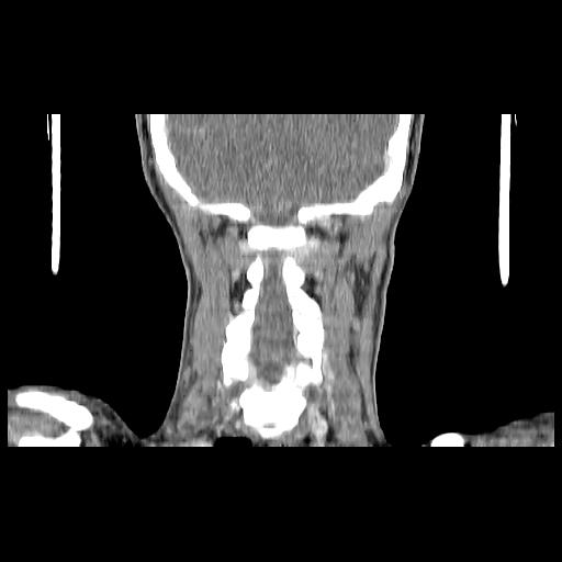 Carcinoma of the maxillary antrum (Radiopaedia 53805-59888 Coronal C+ delayed 128).jpg