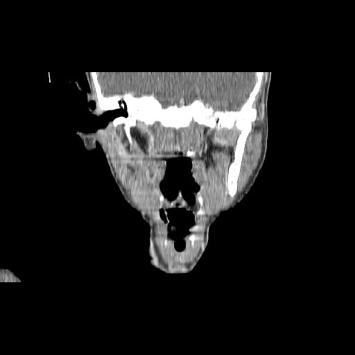 Carcinoma of the maxillary antrum (Radiopaedia 53805-59888 Coronal C+ delayed 88).jpg