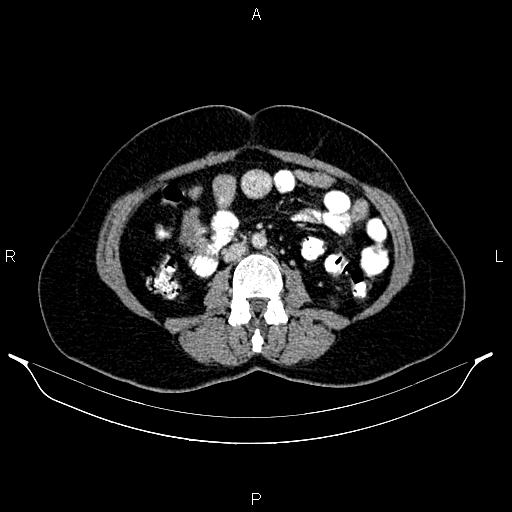 File:Carcinoma of uterine cervix (Radiopaedia 85861-101700 A 50).jpg