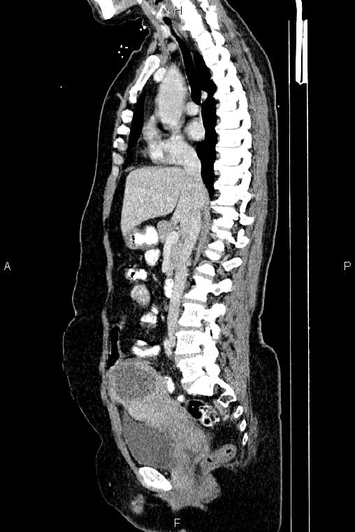 Carcinoma of uterine cervix (Radiopaedia 85861-101700 D 37).jpg