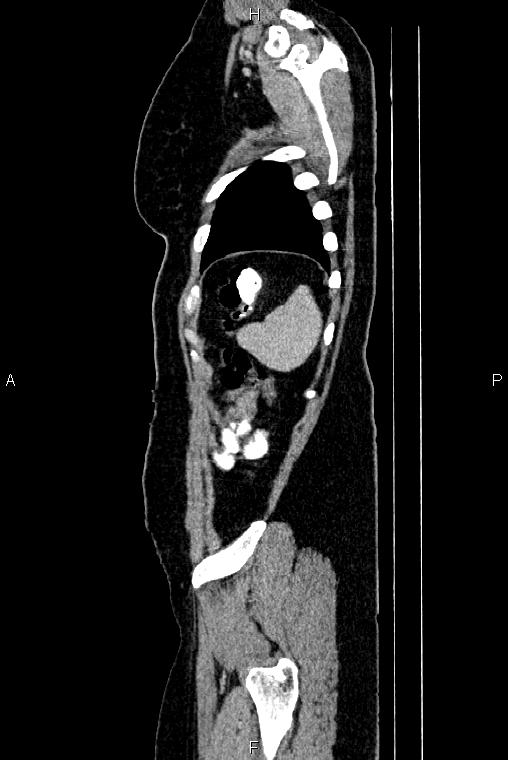 Carcinoma of uterine cervix (Radiopaedia 85861-101700 D 80).jpg