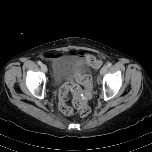 Carcinosarcoma (Radiopaedia 70401-80503 A 59).jpg