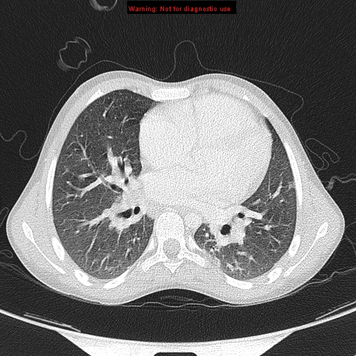 File:Cardiac bronchus (Radiopaedia 14059-13899 A 30).jpg