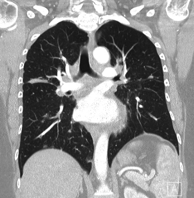 Cardiac sarcoidosis (Radiopaedia 74548-85534 Coronal lung window 38).jpg