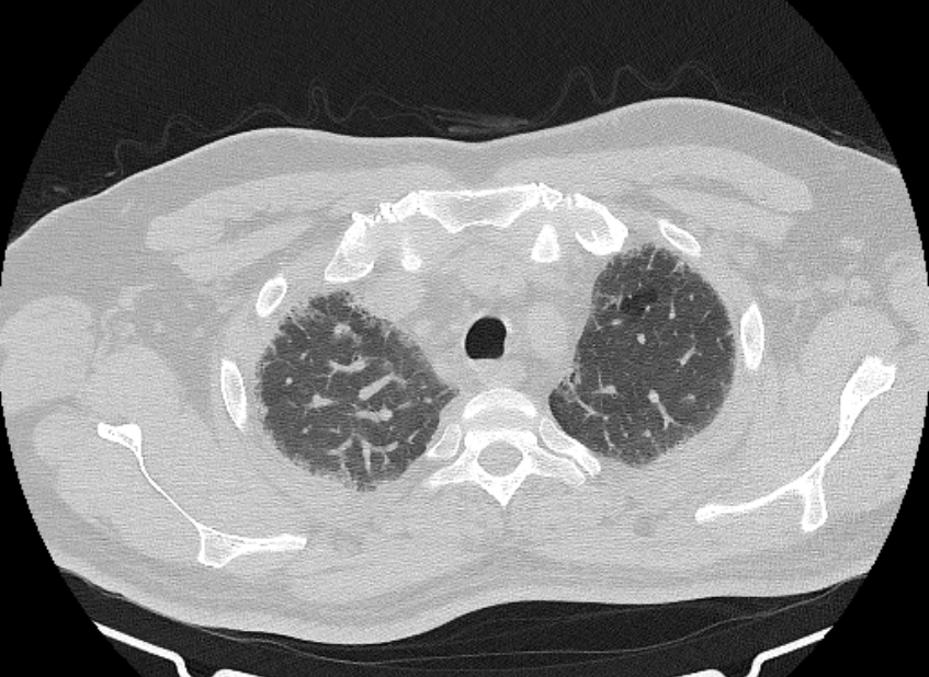 Cardiogenic pulmonary edema (Radiopaedia 68180-77678 Axial lung window 13).jpg