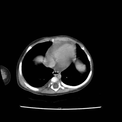 File:Caroli disease with autosomal recessive polycystic kidney disease (ARPKD) (Radiopaedia 89651-106703 B 9).jpg