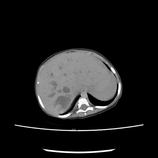File:Caroli disease with autosomal recessive polycystic kidney disease (ARPKD) (Radiopaedia 89651-106703 E 35).jpg