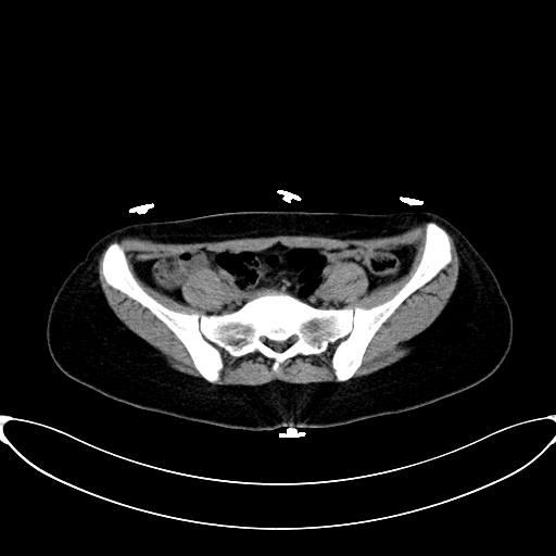 Caroli disease with medullary sponge kidney (Radiopaedia 82622-96804 Axial non-contrast 56).jpg
