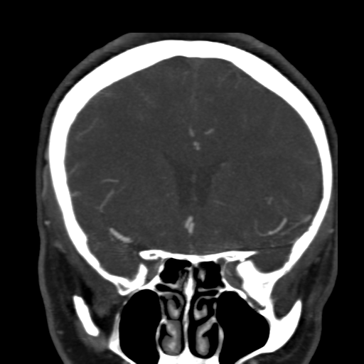 File:Carotico ophthalmic aneurysm (Radiopaedia 42916-46148 B 1).png