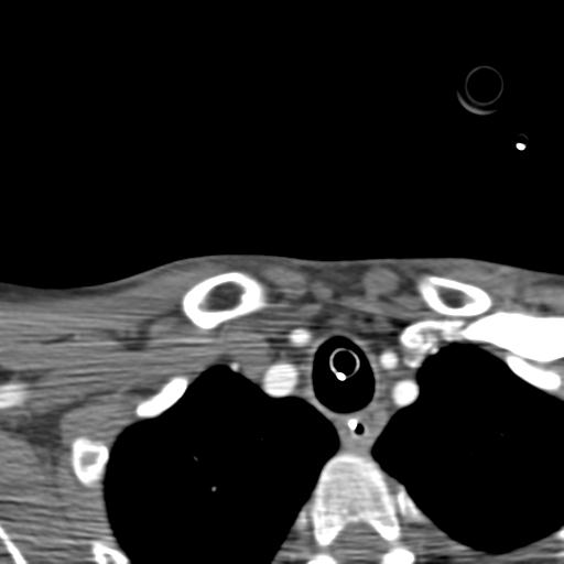 File:Carotid arterial dissection (Radiopaedia 30001-30548 B 22).jpg