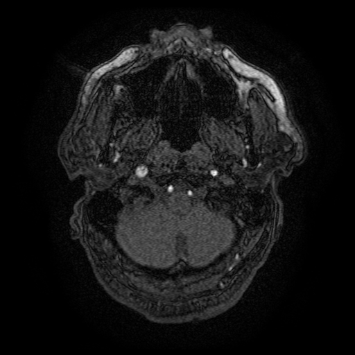 Carotid arterial dissection with acute cerebral infarction (Radiopaedia 26636-26784 MRA 161).jpg