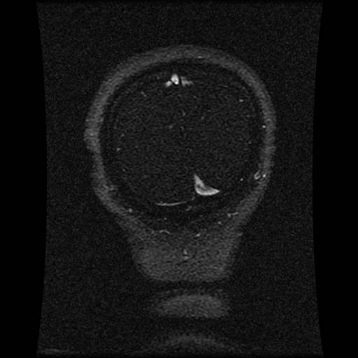 Carotid arterial dissection with acute cerebral infarction (Radiopaedia 26636-26784 MRV 42).jpg