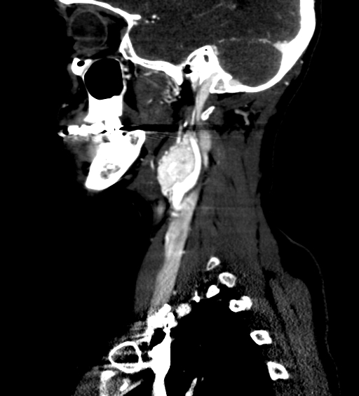 File:Carotid body tumor (Radiopaedia 39845-42300 D 22).jpg