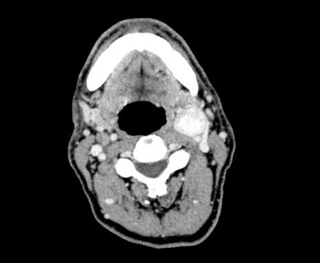 Carotid body tumor (Radiopaedia 61750-69757 Axial Post contrast 43).jpg