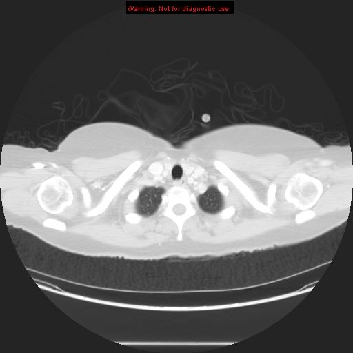 Carotid body tumor with lung metastases (Radiopaedia 9301-48390 Axial lung window 12).jpg