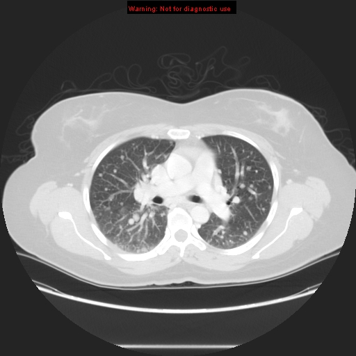 Carotid body tumor with lung metastases (Radiopaedia 9301-48390 Axial lung window 32).jpg