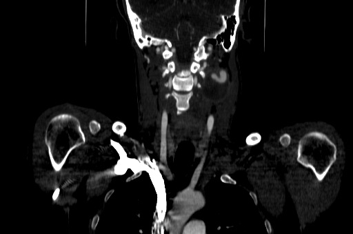 File:Carotid bulb pseudoaneurysm (Radiopaedia 57670-64616 D 40).jpg
