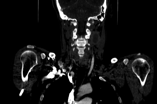 File:Carotid bulb pseudoaneurysm (Radiopaedia 57670-64616 D 47).jpg