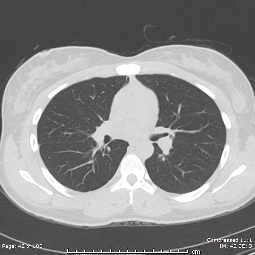 Catamenial pneumothorax (Radiopaedia 54382-60600 Axial non-contrast 42).jpg