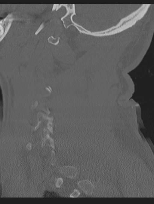 Cavernoma of cervical cord (Radiopaedia 50838-56346 Sagittal bone window 63).png