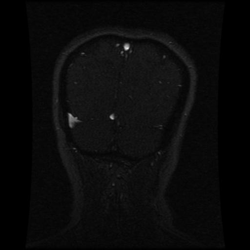 Cavernoma with developmental venous anomaly (Radiopaedia 22470-22507 MRV 36).jpg