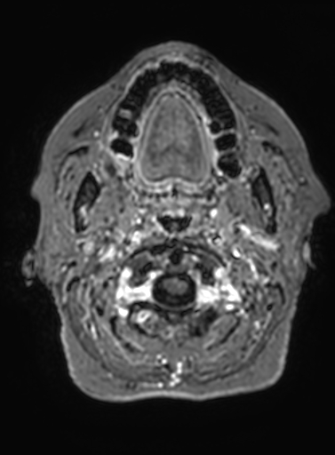 Cavernous hemangioma of the cerebellar falx (Radiopaedia 73025-83724 Axial T1 C+ 339).jpg