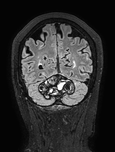 Cavernous hemangioma of the cerebellar falx (Radiopaedia 73025-83724 Coronal FLAIR 283).jpg