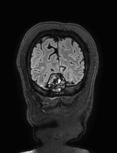 Cavernous hemangioma of the cerebellar falx (Radiopaedia 73025-83724 Coronal FLAIR 324).jpg