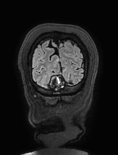 Cavernous hemangioma of the cerebellar falx (Radiopaedia 73025-83724 Coronal FLAIR 328).jpg
